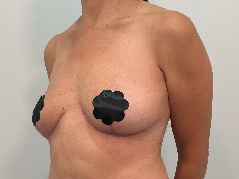 Breast Augmentation-Mastopexy Before & After Gallery - Patient 219491 - Image 10