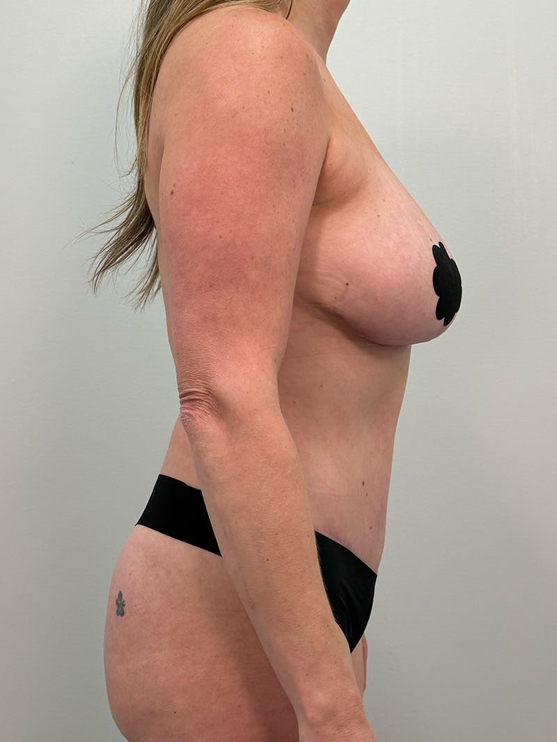 Mommy Makeover Before & After Gallery - Patient 238729 - Image 6