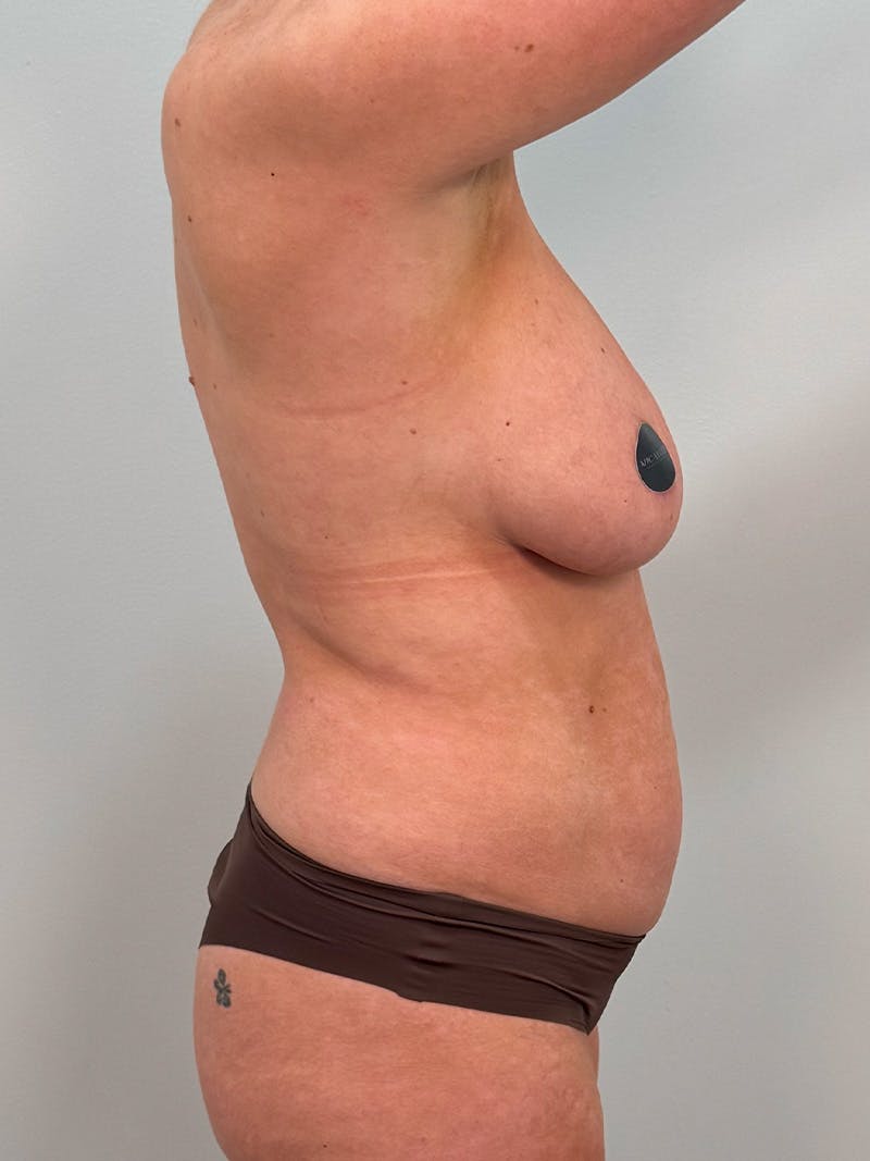 Mommy Makeover Before & After Gallery - Patient 238729 - Image 7