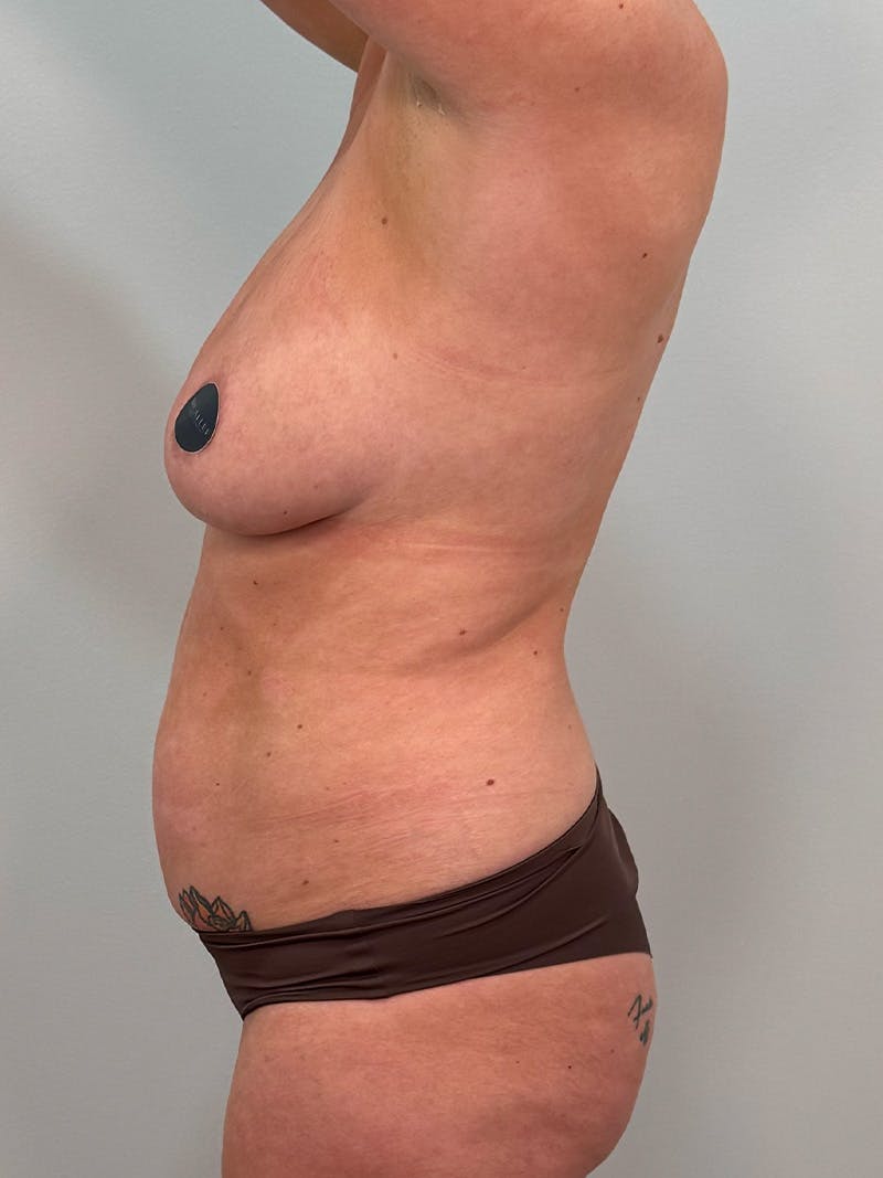 Mommy Makeover Before & After Gallery - Patient 238729 - Image 13