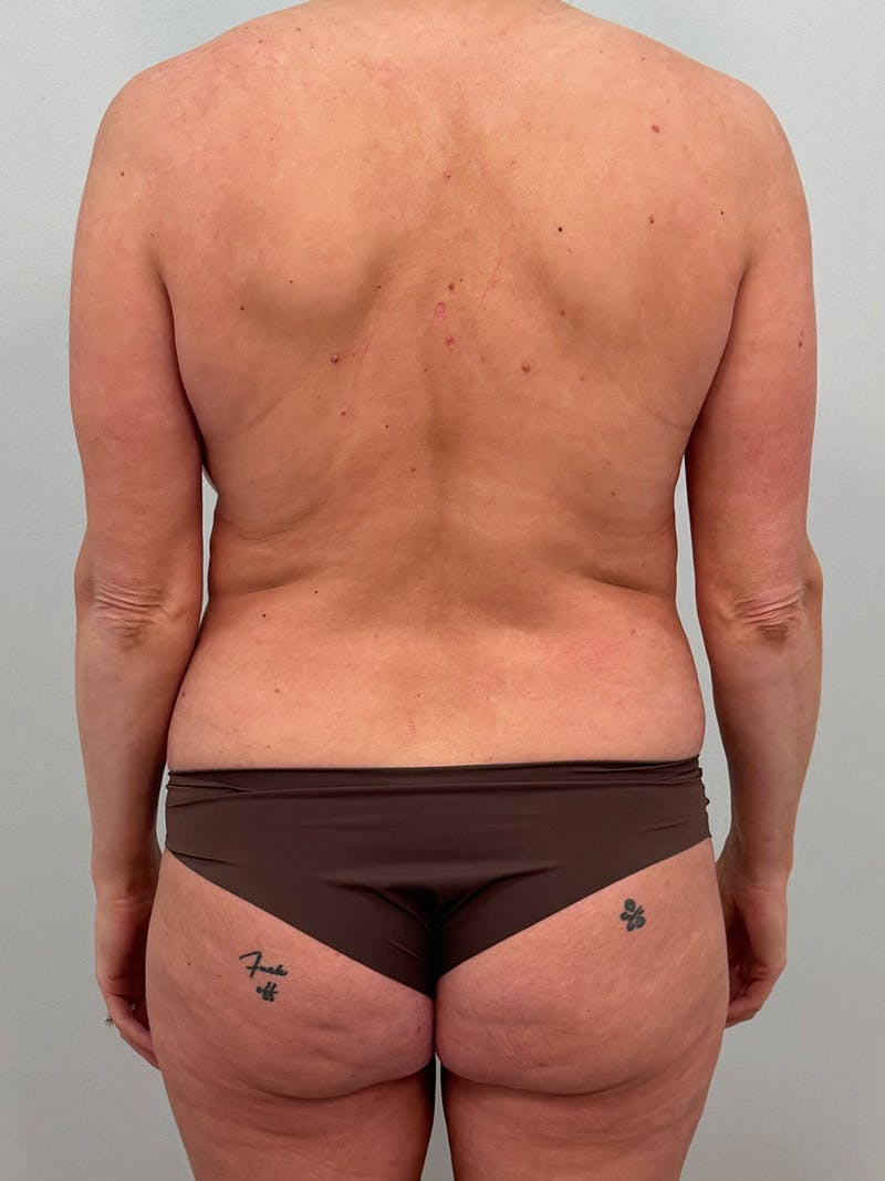 Mommy Makeover Before & After Gallery - Patient 238729 - Image 15