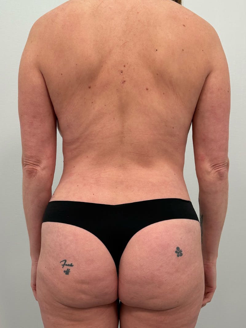 Mommy Makeover Before & After Gallery - Patient 238729 - Image 16
