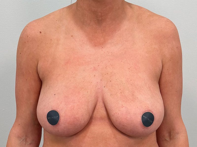 Breast Augmentation-Mastopexy Before & After Gallery - Patient 290267 - Image 1