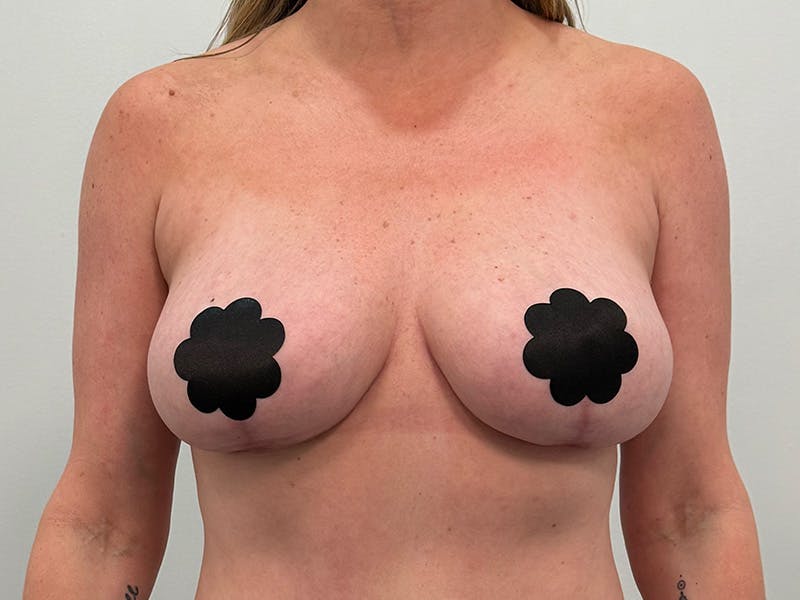 Breast Augmentation-Mastopexy Before & After Gallery - Patient 290267 - Image 2