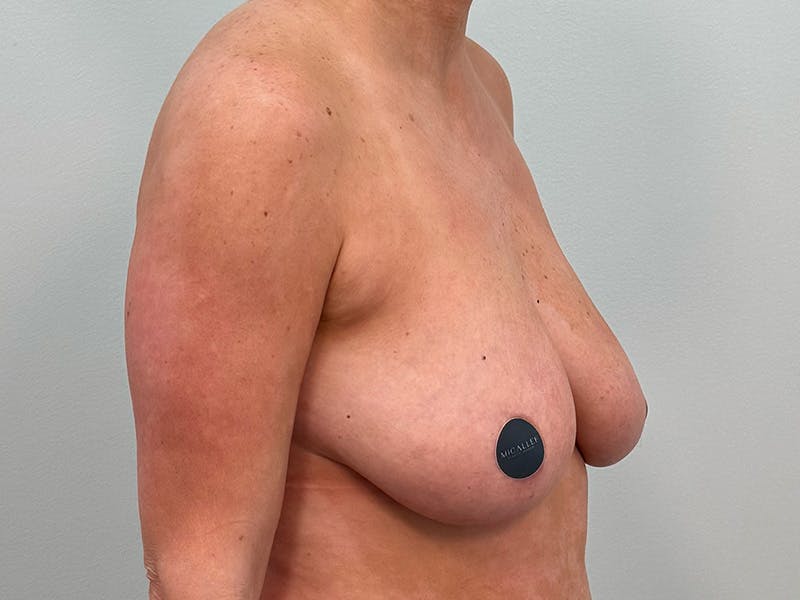 Breast Augmentation-Mastopexy Before & After Gallery - Patient 290267 - Image 3