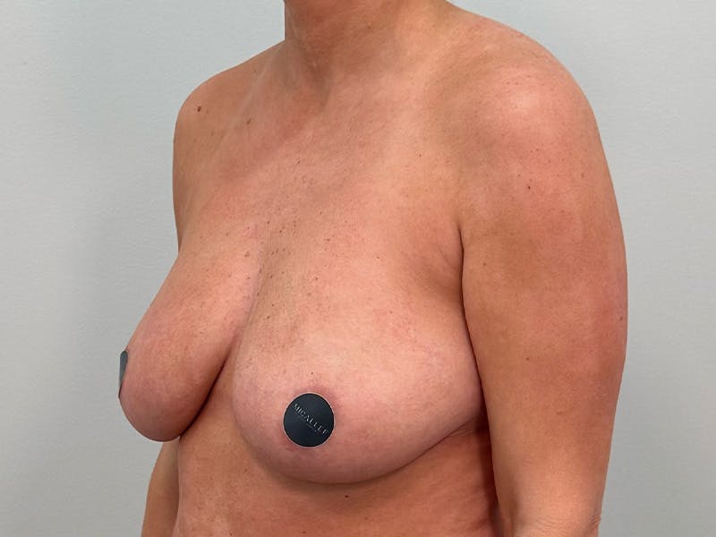 Breast Augmentation-Mastopexy Before & After Gallery - Patient 290267 - Image 9