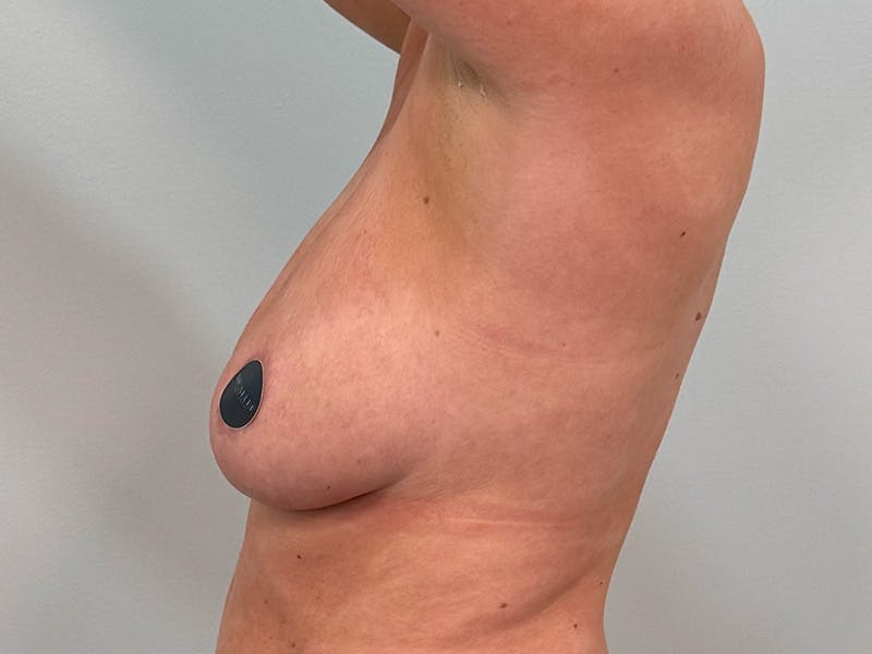 Breast Augmentation-Mastopexy Before & After Gallery - Patient 290267 - Image 11