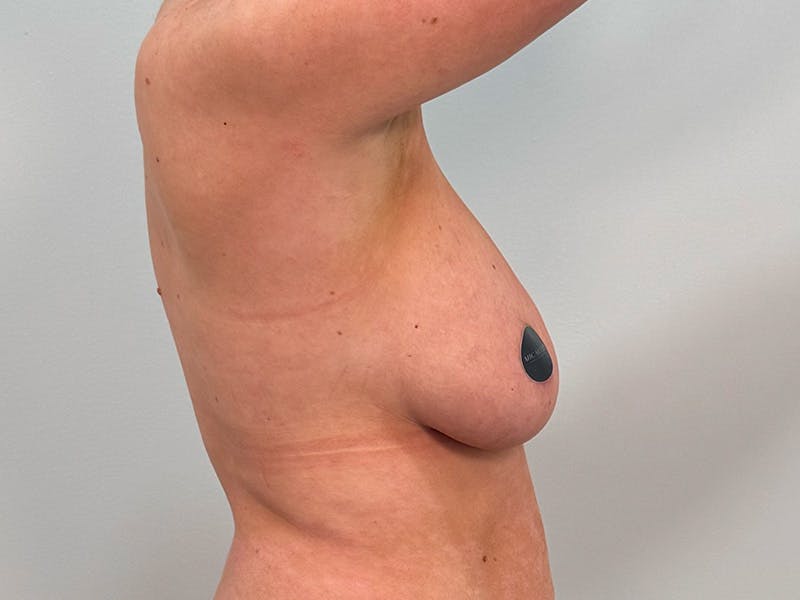 Breast Augmentation-Mastopexy Before & After Gallery - Patient 290267 - Image 7