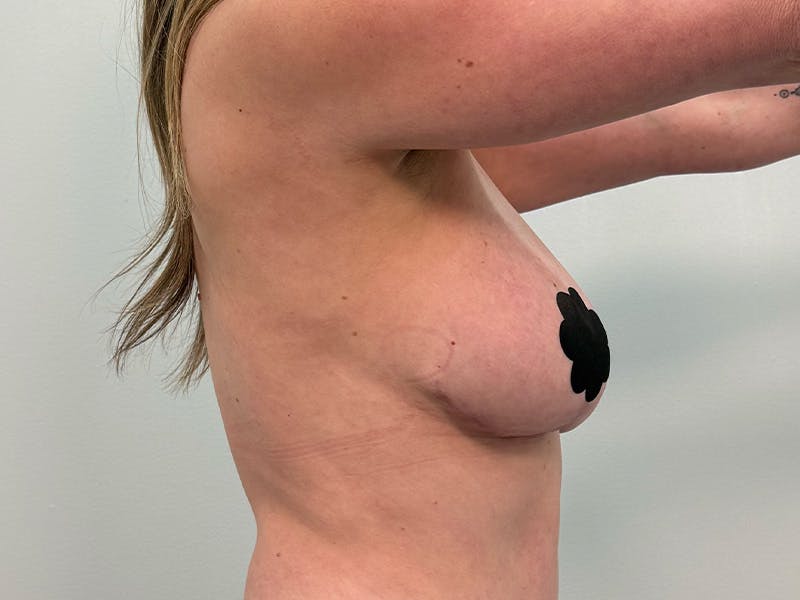 Breast Augmentation-Mastopexy Before & After Gallery - Patient 290267 - Image 8