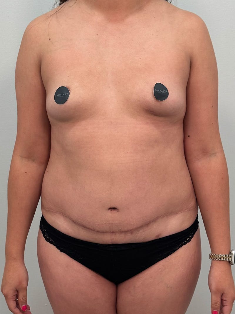 Mommy Makeover Before & After Gallery - Patient 187314 - Image 1
