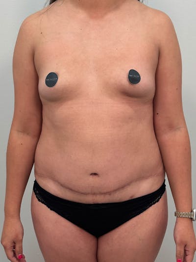 Mommy Makeover Before & After Gallery - Patient 187314 - Image 1