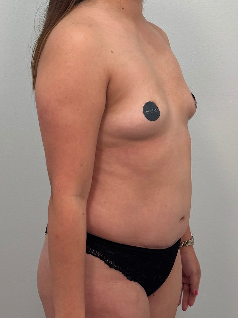 Mommy Makeover Before & After Gallery - Patient 187314 - Image 3