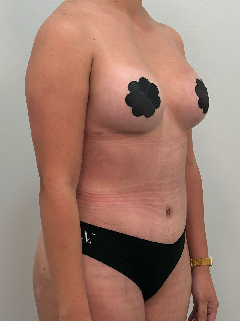 Mommy Makeover Before & After Gallery - Patient 187314 - Image 4