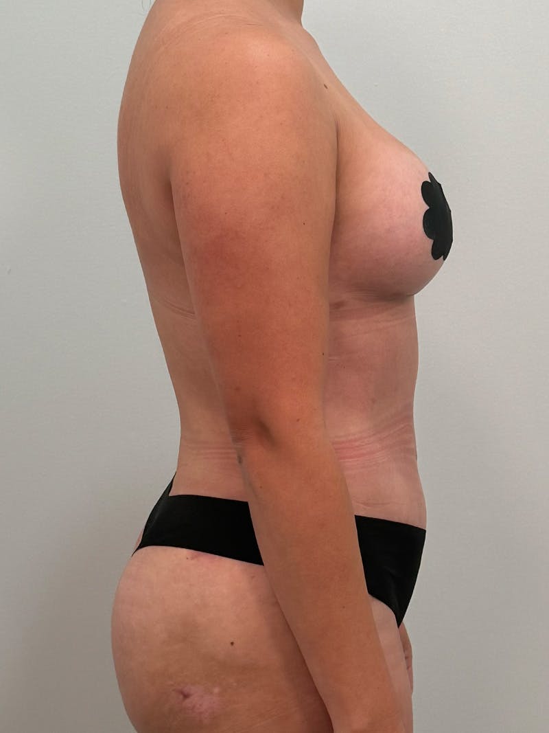 Mommy Makeover Before & After Gallery - Patient 187314 - Image 6