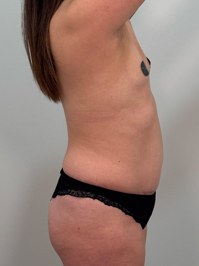 Mommy Makeover Before & After Gallery - Patient 187314 - Image 7