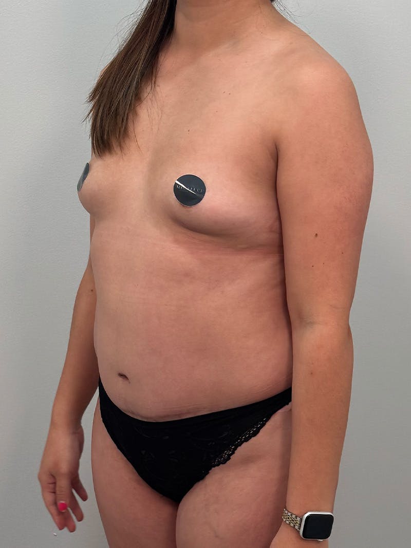 Mommy Makeover Before & After Gallery - Patient 187314 - Image 9