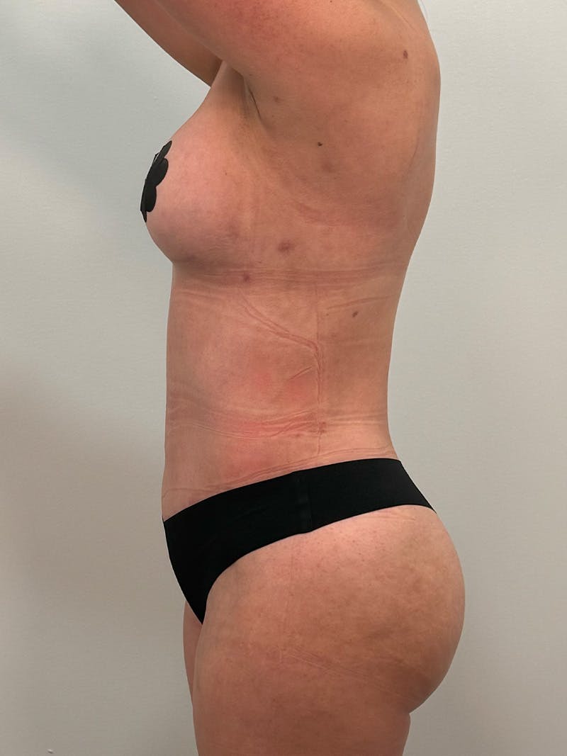 Mommy Makeover Before & After Gallery - Patient 187314 - Image 12
