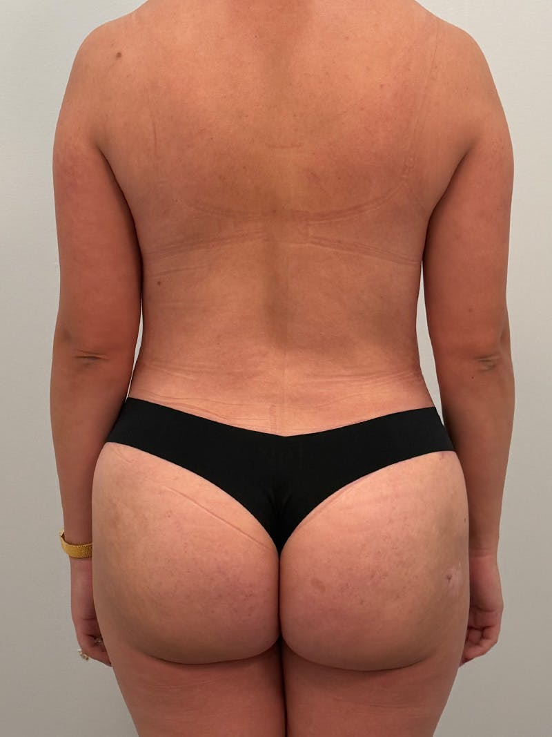 Mommy Makeover Before & After Gallery - Patient 187314 - Image 14