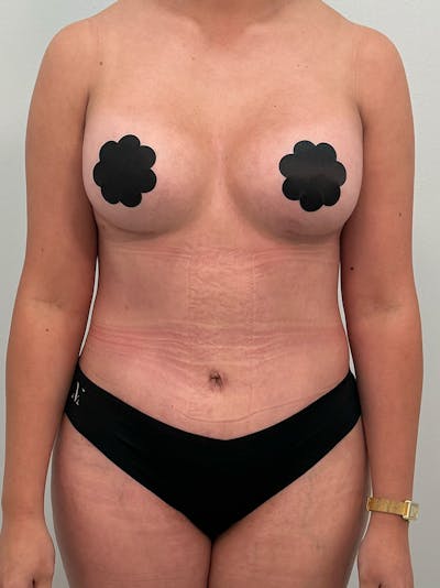Mommy Makeover Before & After Gallery - Patient 187314 - Image 2