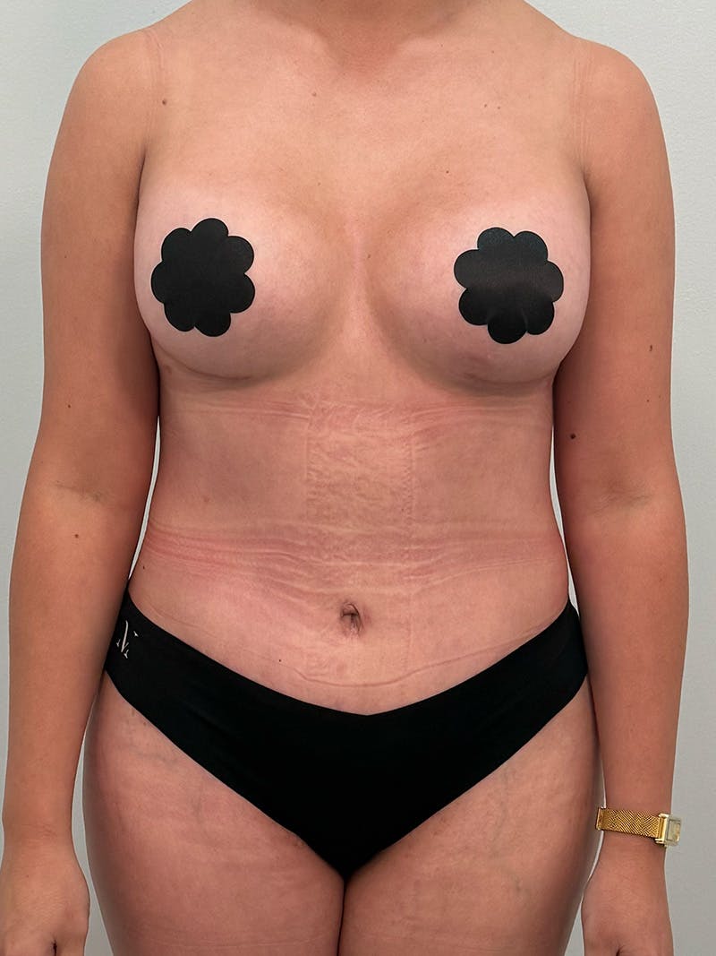Mommy Makeover Before & After Gallery - Patient 187314 - Image 2