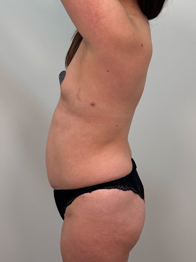 Mommy Makeover Before & After Gallery - Patient 187314 - Image 11