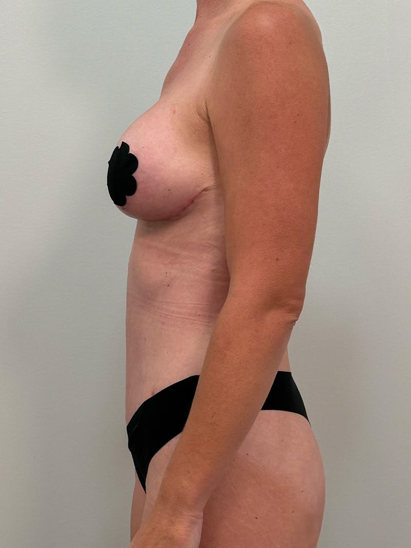Mommy Makeover Before & After Gallery - Patient 109591 - Image 8