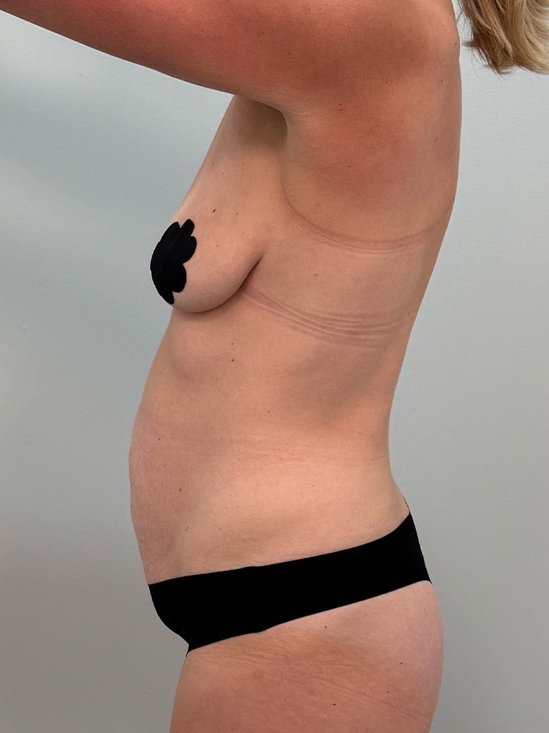 Mommy Makeover Before & After Gallery - Patient 109591 - Image 9