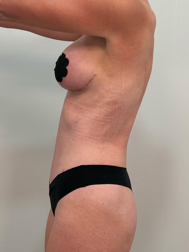 Mommy Makeover Before & After Gallery - Patient 109591 - Image 10