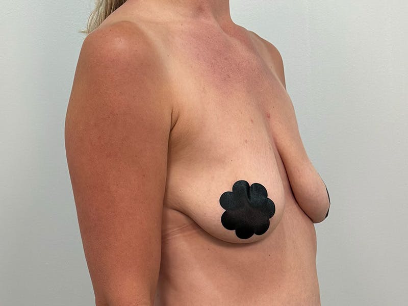 Breast Augmentation-Mastopexy Before & After Gallery - Patient 446375 - Image 1
