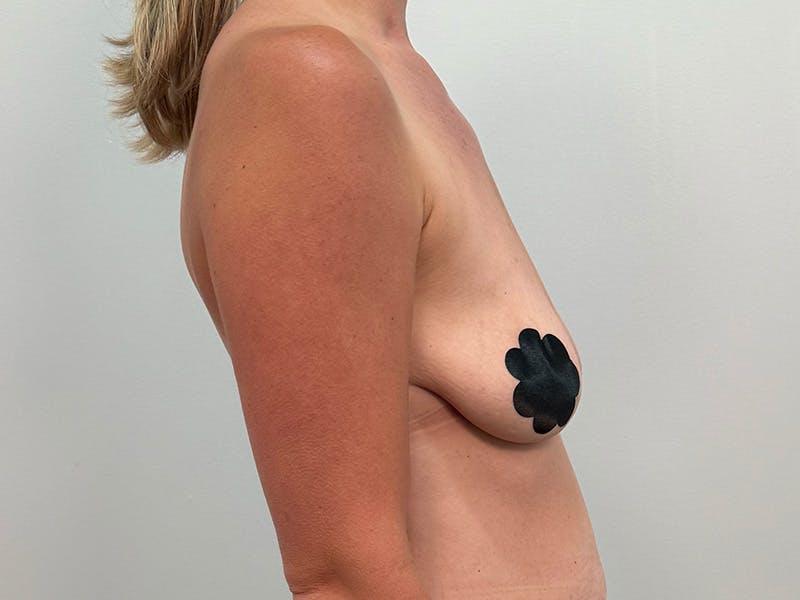 Breast Augmentation-Mastopexy Before & After Gallery - Patient 446375 - Image 3