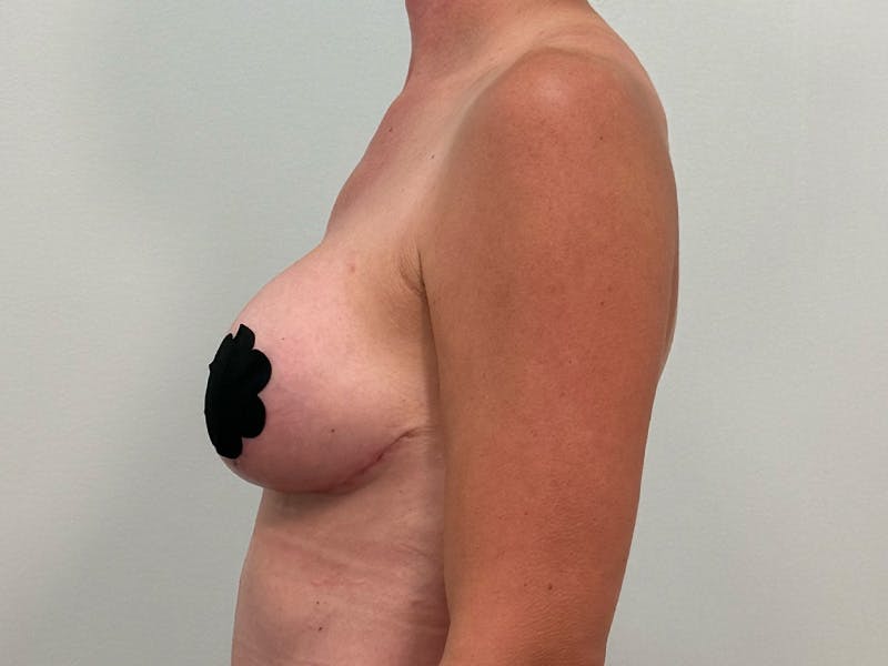 Breast Augmentation-Mastopexy Before & After Gallery - Patient 446375 - Image 6
