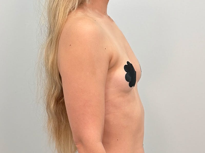 Breast Augmentation Before & After Gallery - Patient 111908 - Image 5