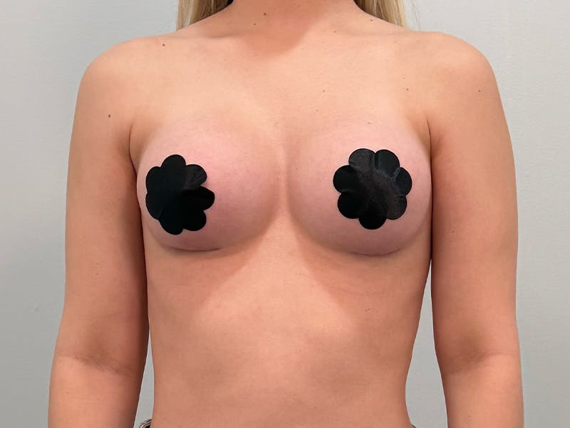 Breast Augmentation Before & After Gallery - Patient 111908 - Image 2