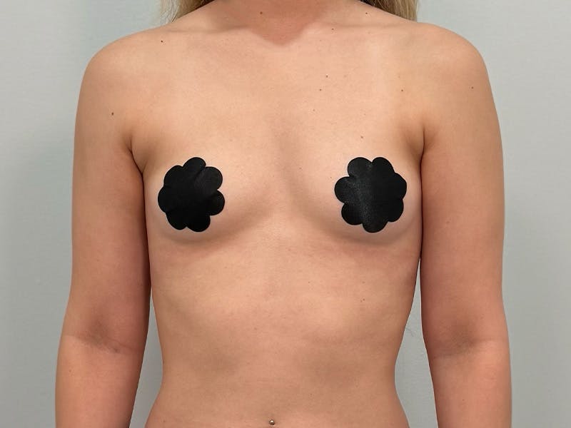 Breast Augmentation Before & After Gallery - Patient 111908 - Image 1
