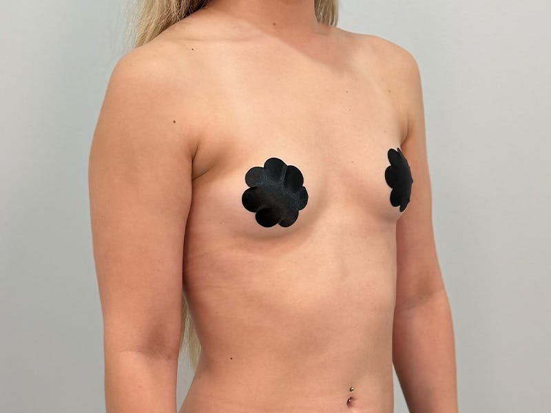 Breast Augmentation Before & After Gallery - Patient 111908 - Image 3