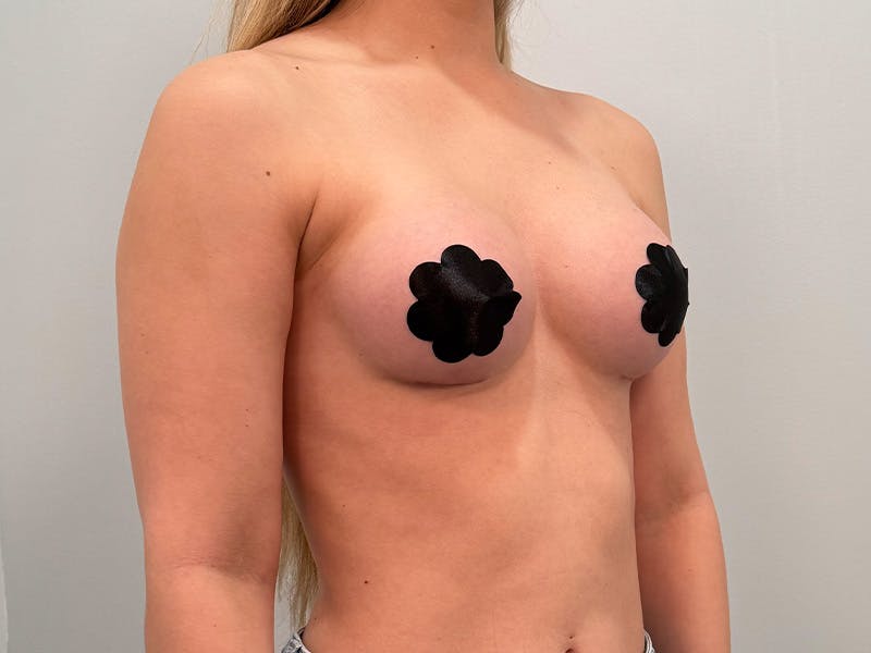 Breast Augmentation Before & After Gallery - Patient 111908 - Image 4
