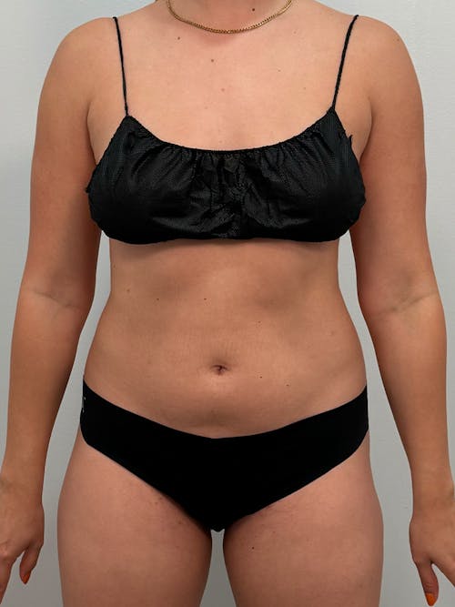 san antonio lipo c injections and B12 support energy, metabolism, and fat processing to help keep you feeling your best and to maximize your hard work in the gym! Support your overall wellness with Liposuction San Antonio, TX -