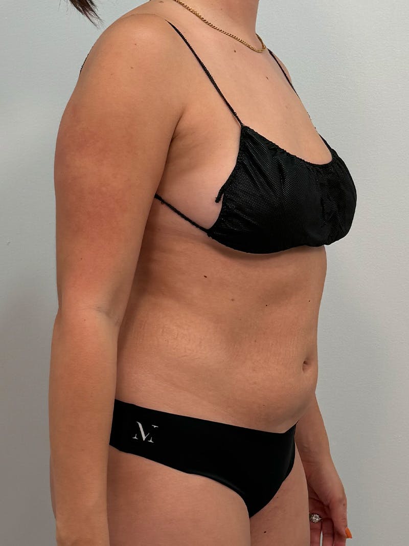 Liposuction Before & After Gallery - Patient 272712 - Image 3