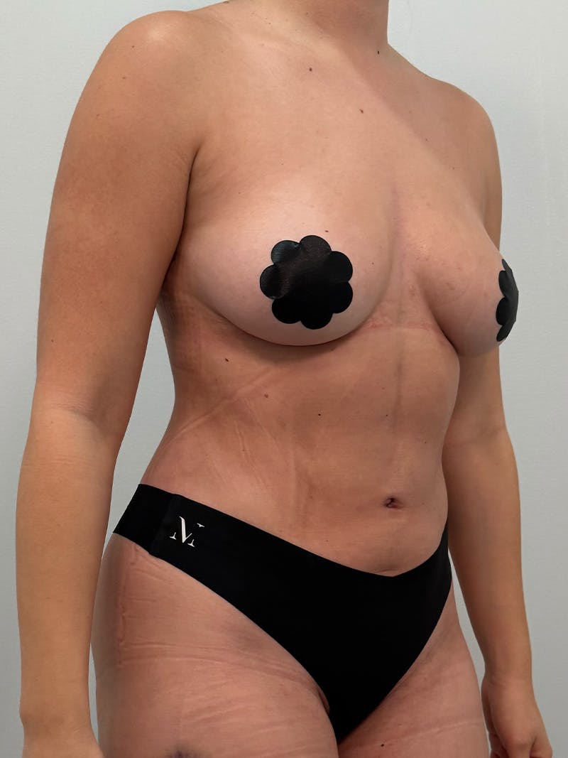 Liposuction Before & After Gallery - Patient 272712 - Image 4