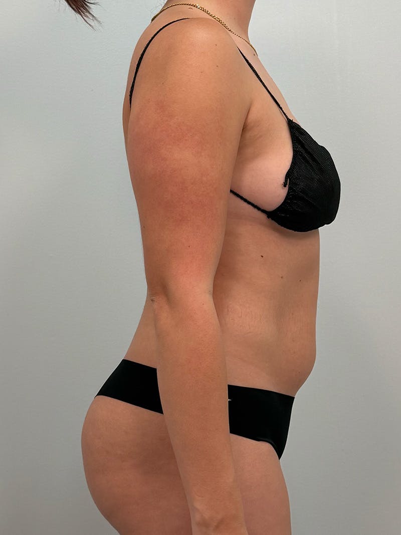 Liposuction Before & After Gallery - Patient 272712 - Image 5