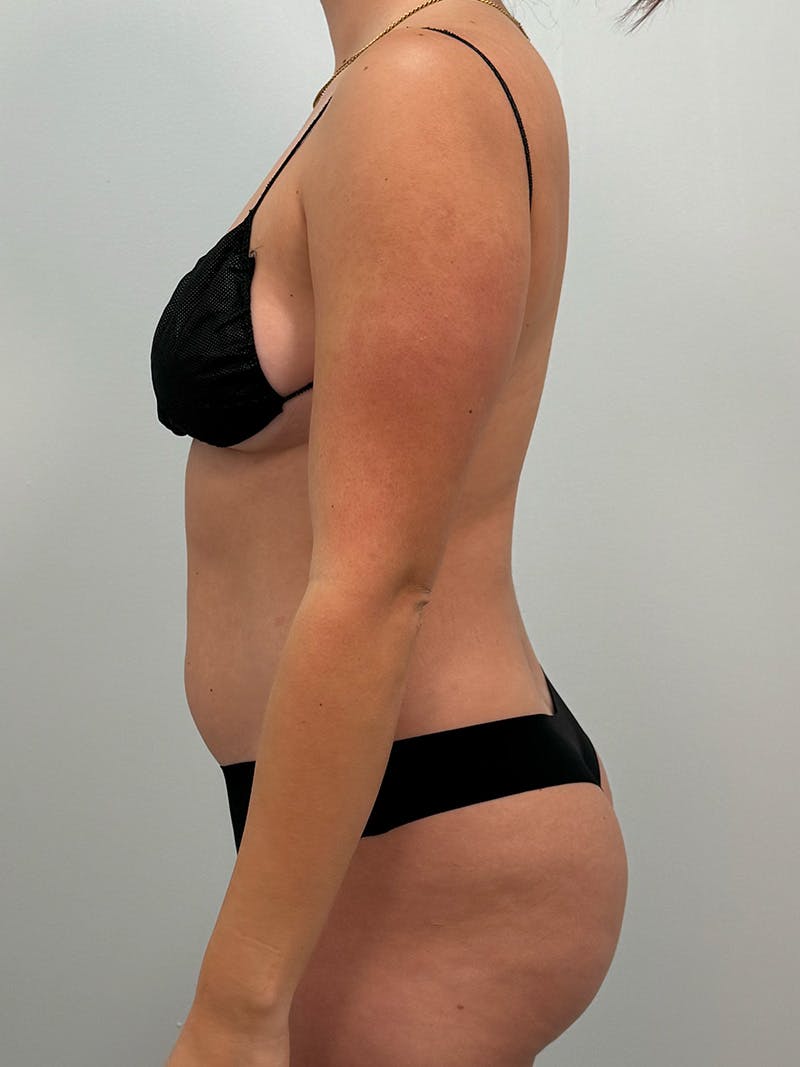 Liposuction Before & After Gallery - Patient 272712 - Image 11