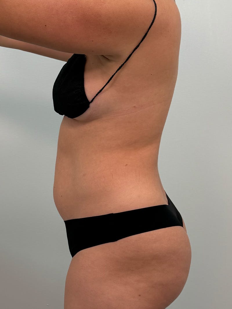 Liposuction Before & After Gallery - Patient 272712 - Image 13