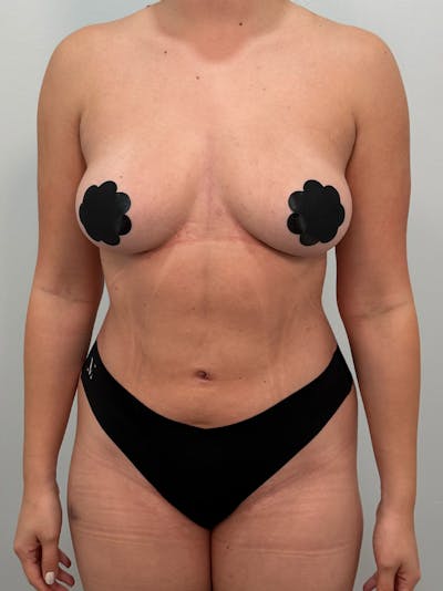 Liposuction Before & After Gallery - Patient 272712 - Image 2