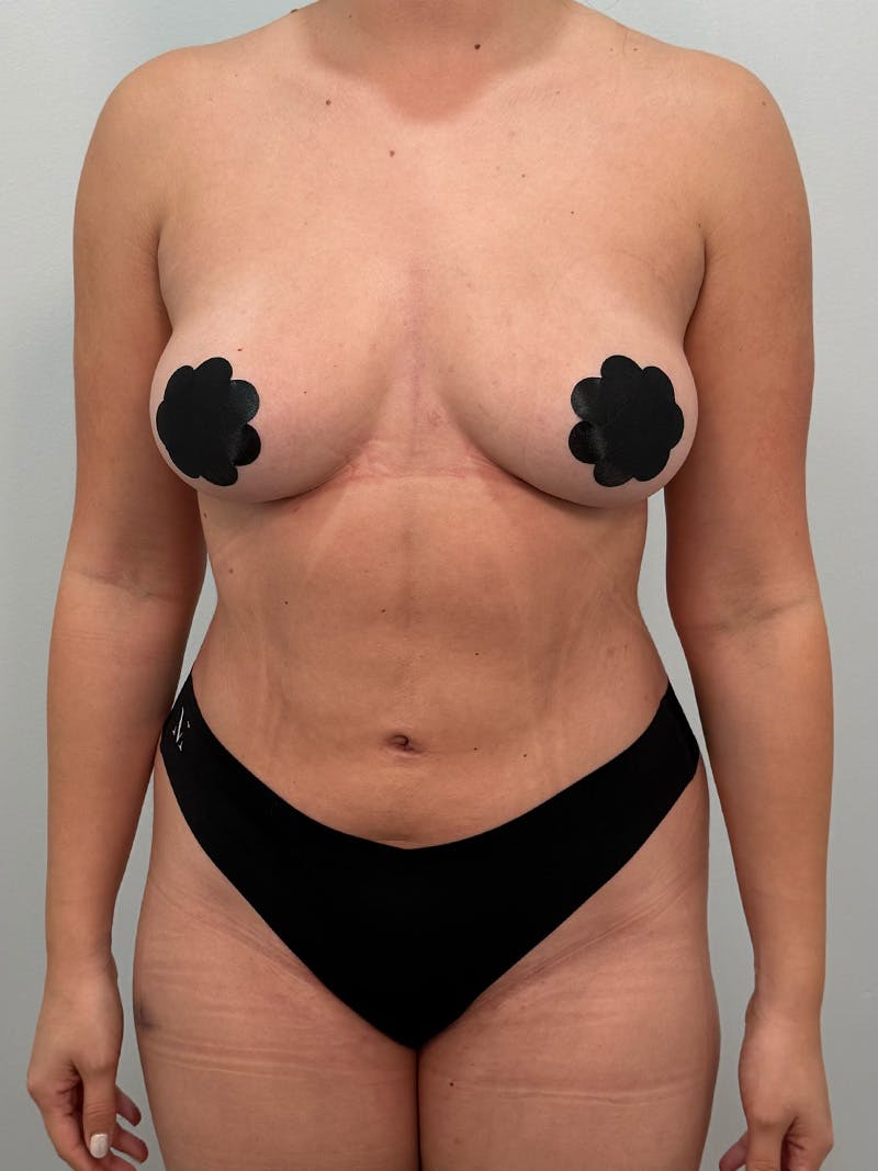 Liposuction Before & After Gallery - Patient 272712 - Image 2