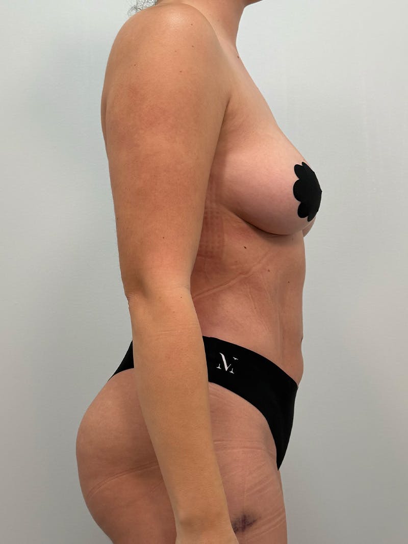 Liposuction Before & After Gallery - Patient 272712 - Image 6