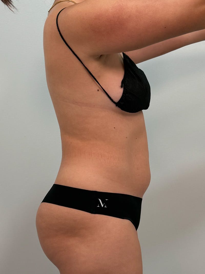 Liposuction Before & After Gallery - Patient 272712 - Image 7