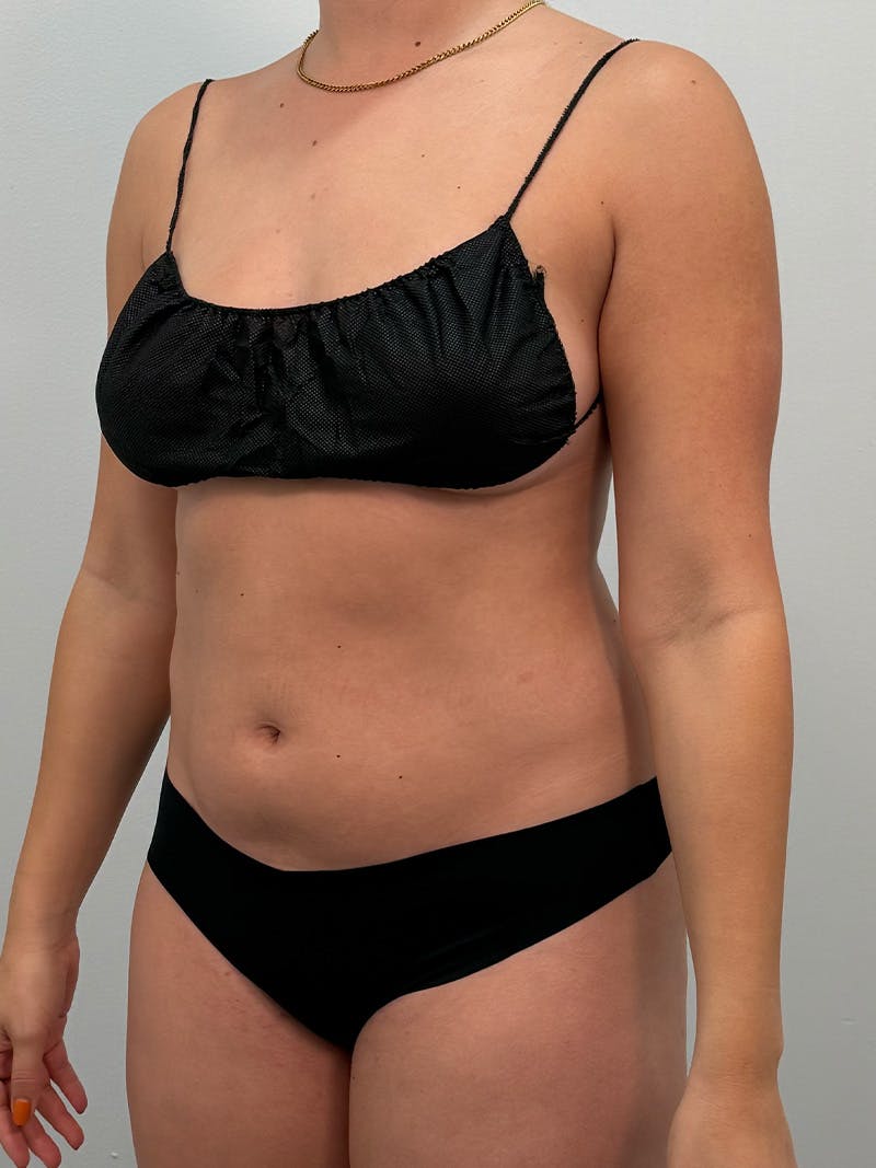 Liposuction Before & After Gallery - Patient 272712 - Image 9