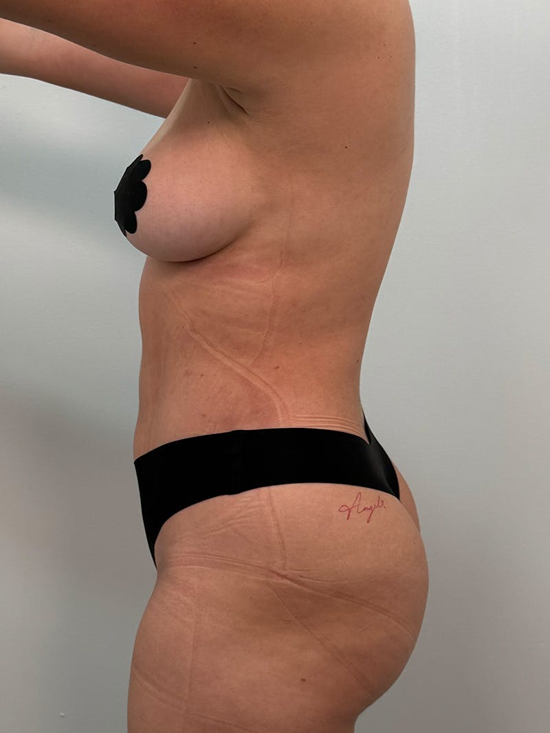 Liposuction Before & After Gallery - Patient 272712 - Image 14