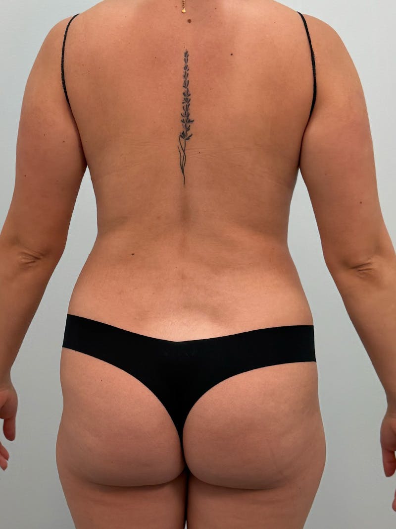 Liposuction Before & After Gallery - Patient 272712 - Image 15