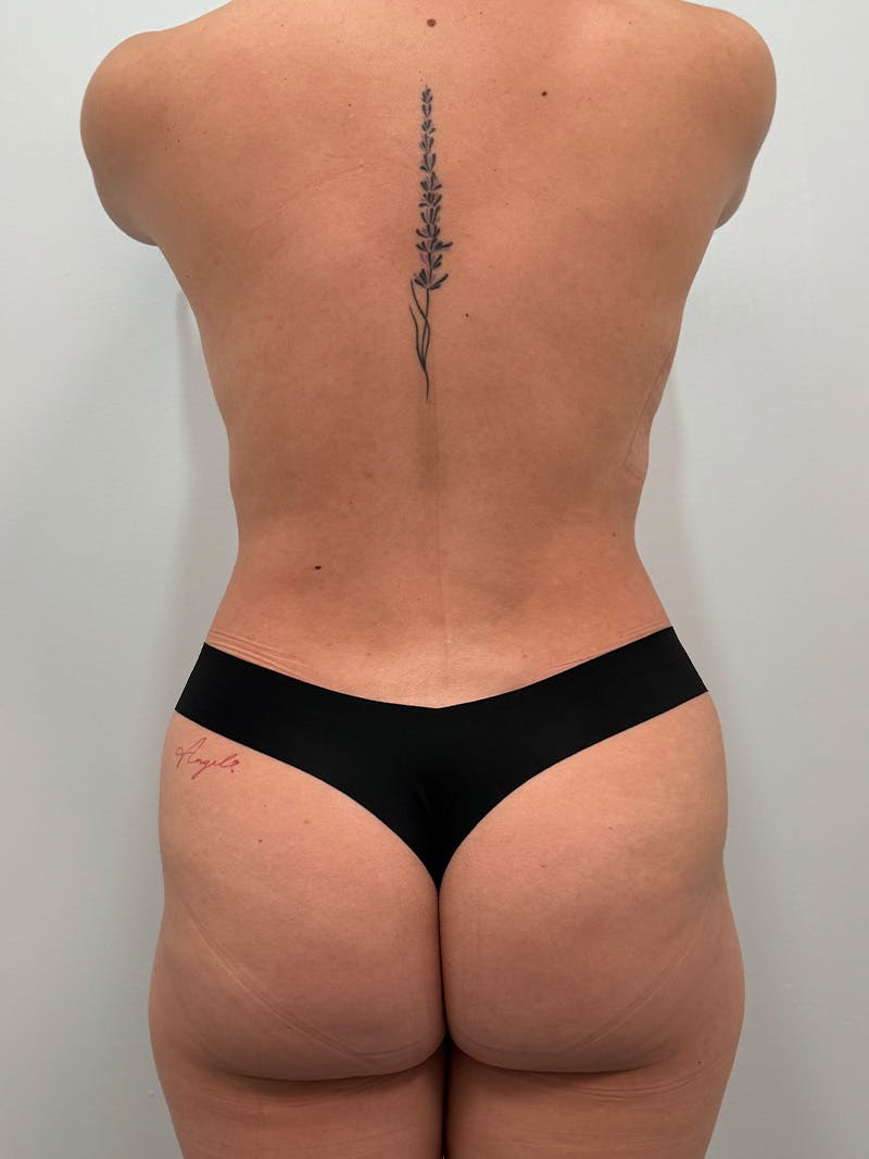 Liposuction Before & After Gallery - Patient 272712 - Image 16